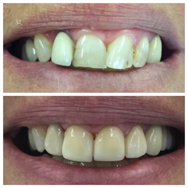 Clinical before-and-after smile photographs, case 1