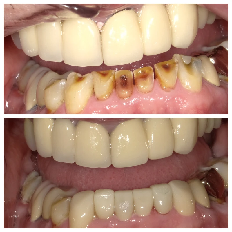 Clinical before-and-after smile photographs, case 10