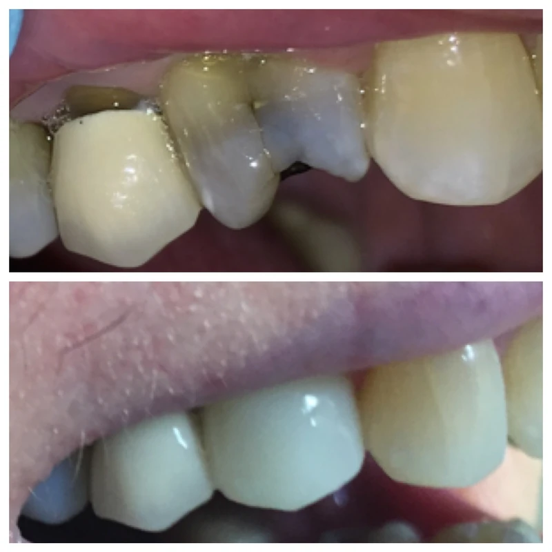 Clinical before-and-after smile photographs, case 11