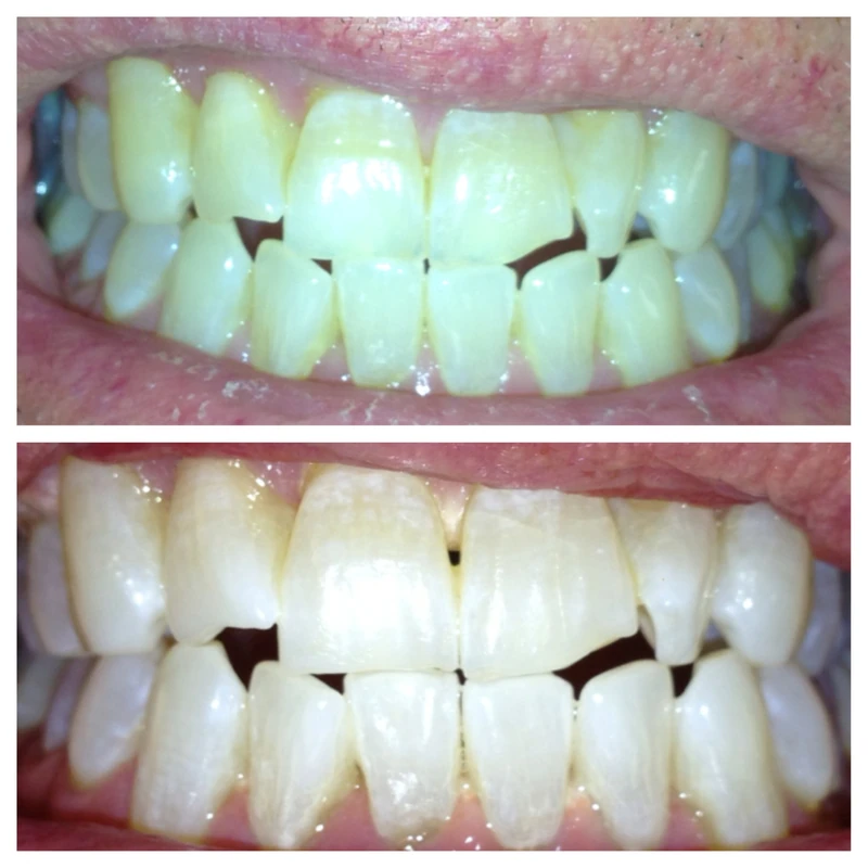 Clinical before-and-after smile photographs, case 12
