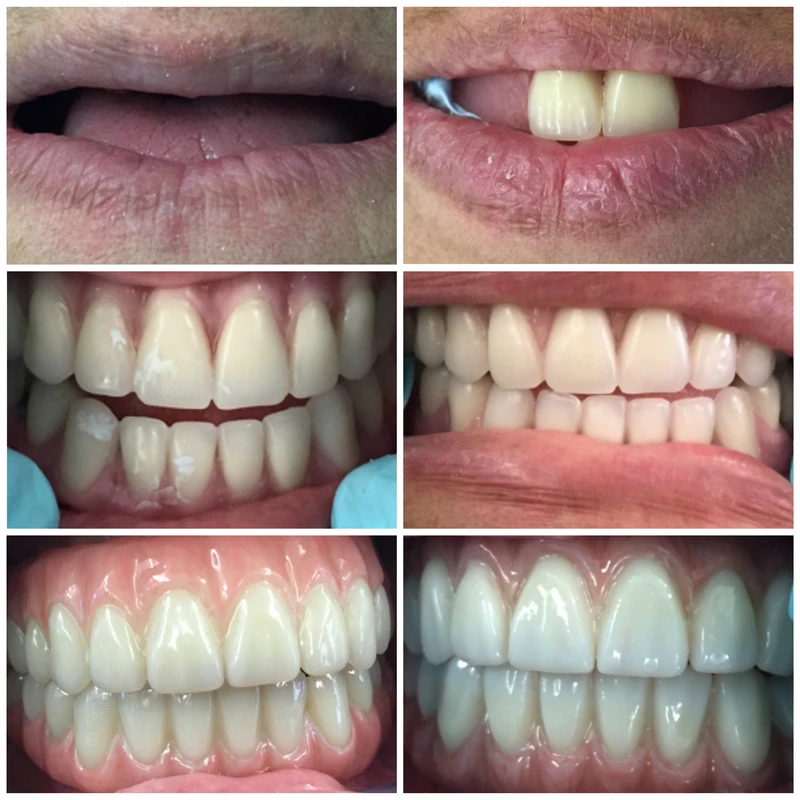 Clinical before-and-after smile photographs, case 13