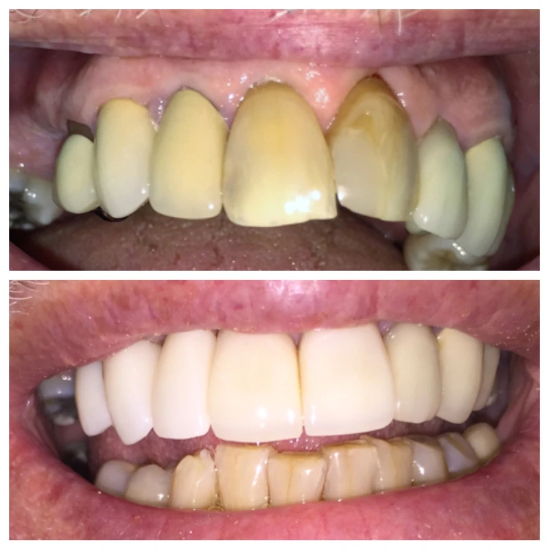 Clinical before-and-after smile photographs, case 2
