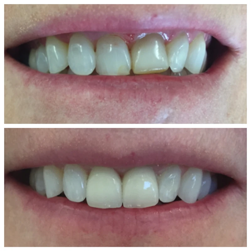 Clinical before-and-after smile photographs, case 3