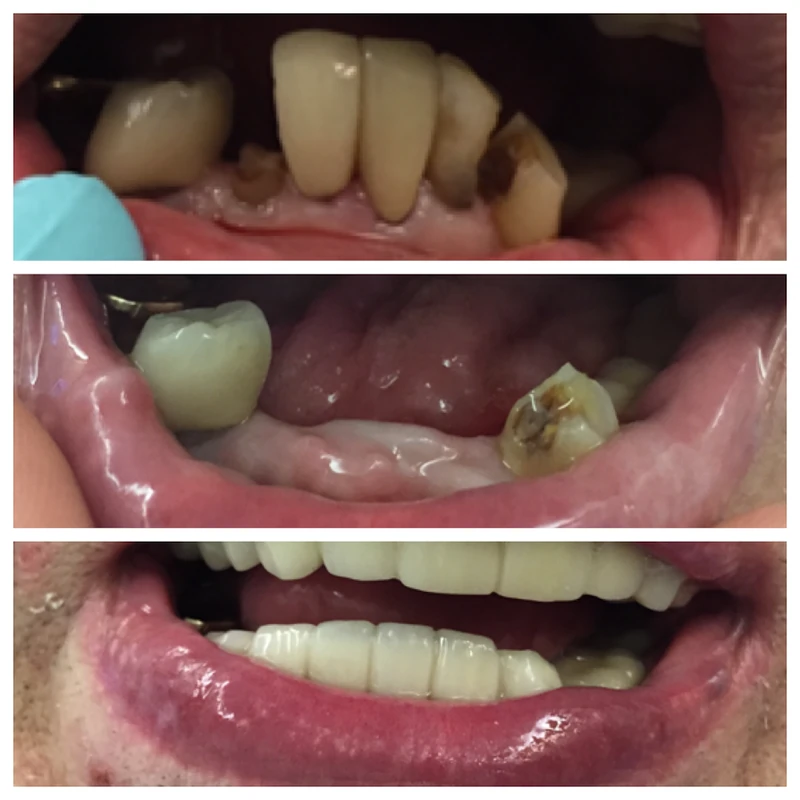 Clinical before-and-after smile photographs, case 4