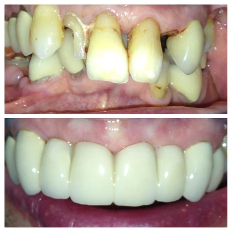 Clinical before-and-after smile photographs, case 5