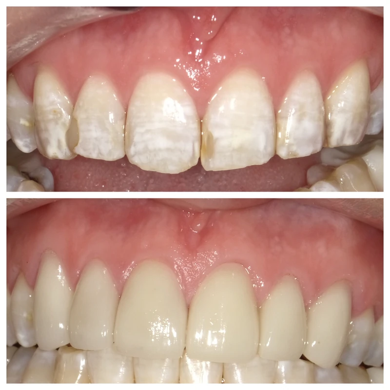 Clinical before-and-after smile photographs, case 6