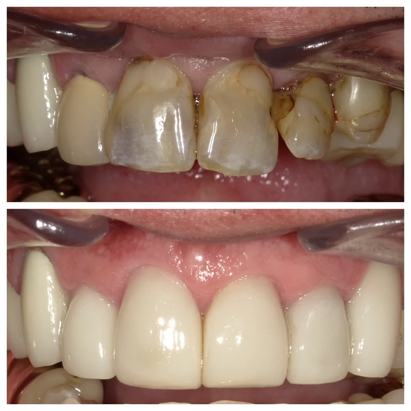 Clinical before-and-after smile photographs, case 7