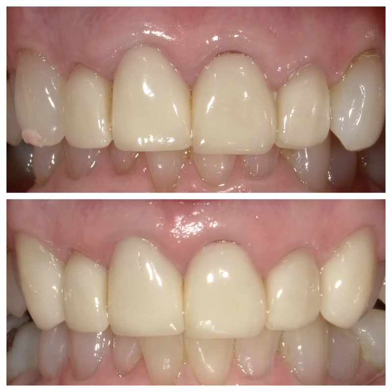 Clinical before-and-after smile photographs, case 8
