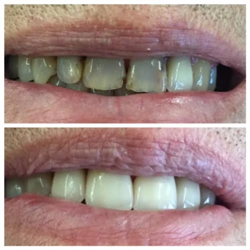 Clinical before-and-after smile photographs, case 9